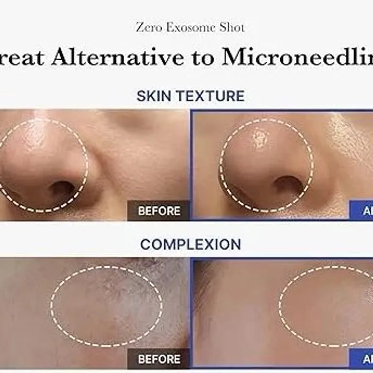 Microagulhamento Medicube Exosome Shot Strong 2000
